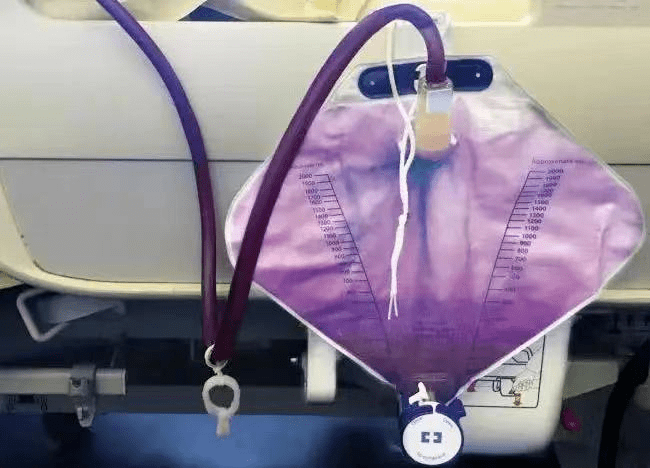 紫色尿袋综合征
